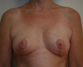 Feel Beautiful - Breast Lift Case 10 - After Photo